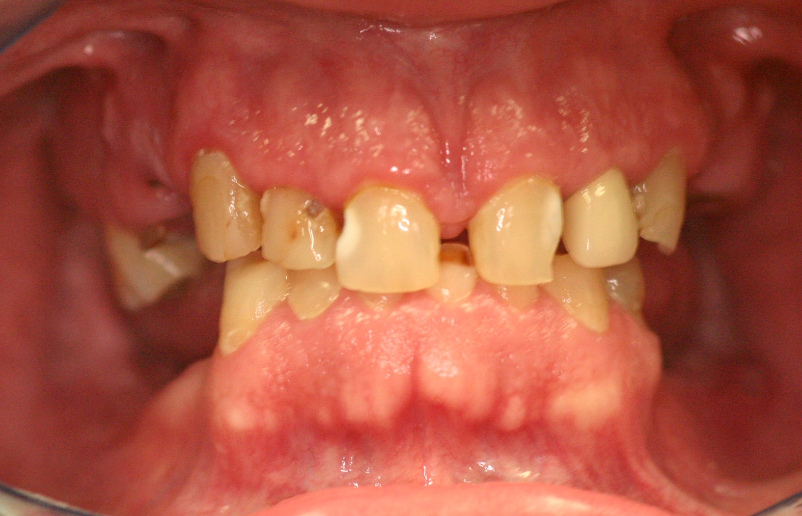 rampant decay in teeth