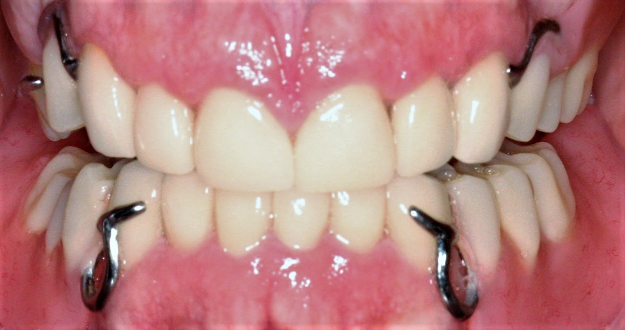 full mouth reconstruction